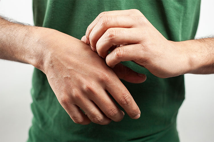 Skin conditions