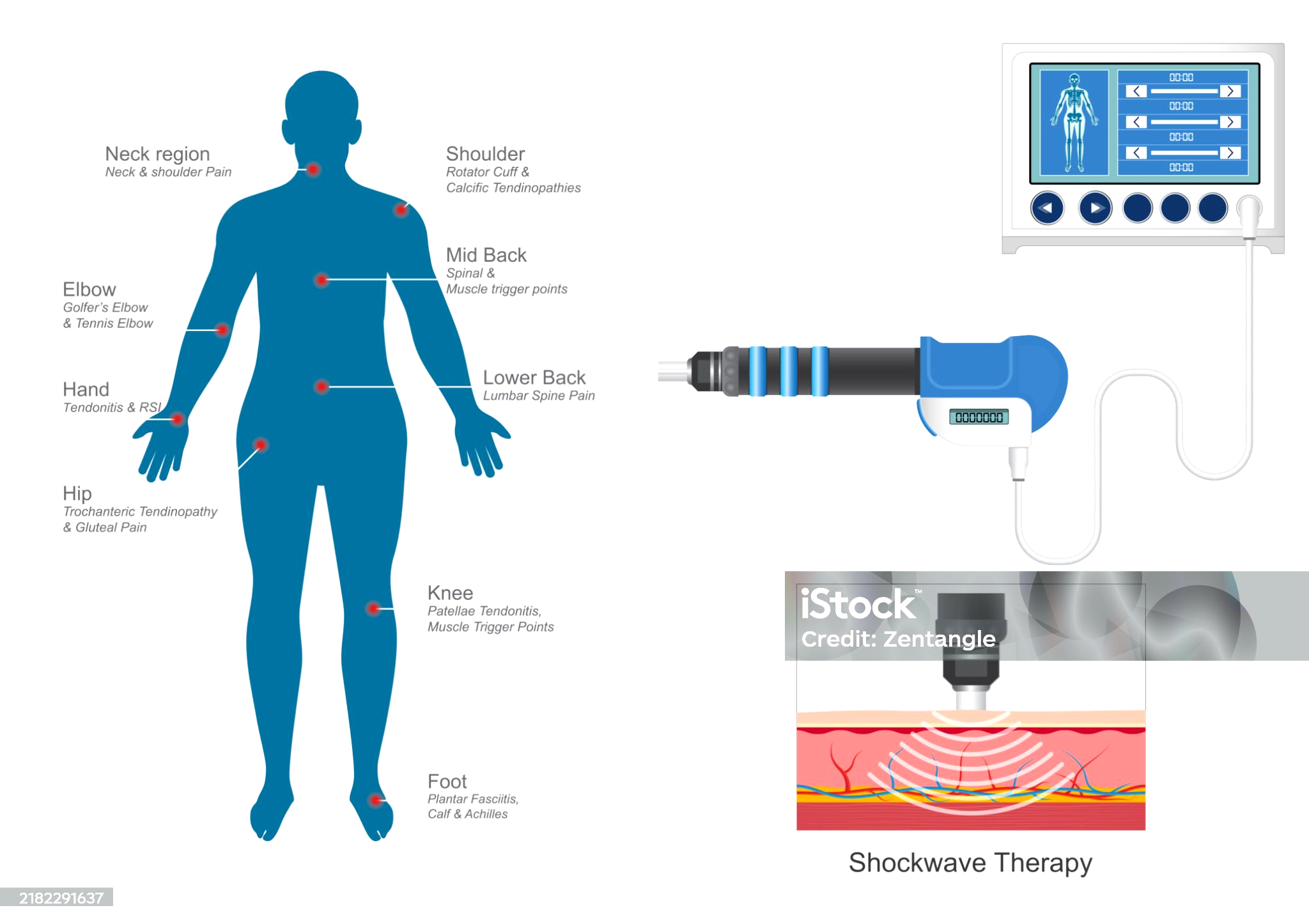 Shockwave Treatment Service in Palmyra, New Jersey